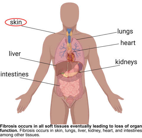 Anatomy diagram of fibrosis. Bottom text reads: Fibrosis occurs in all soft tissues leading to loss of organ function. Fibrosis occurs in skin, lungs, liver, kidney, heart, and intestines among other tissue