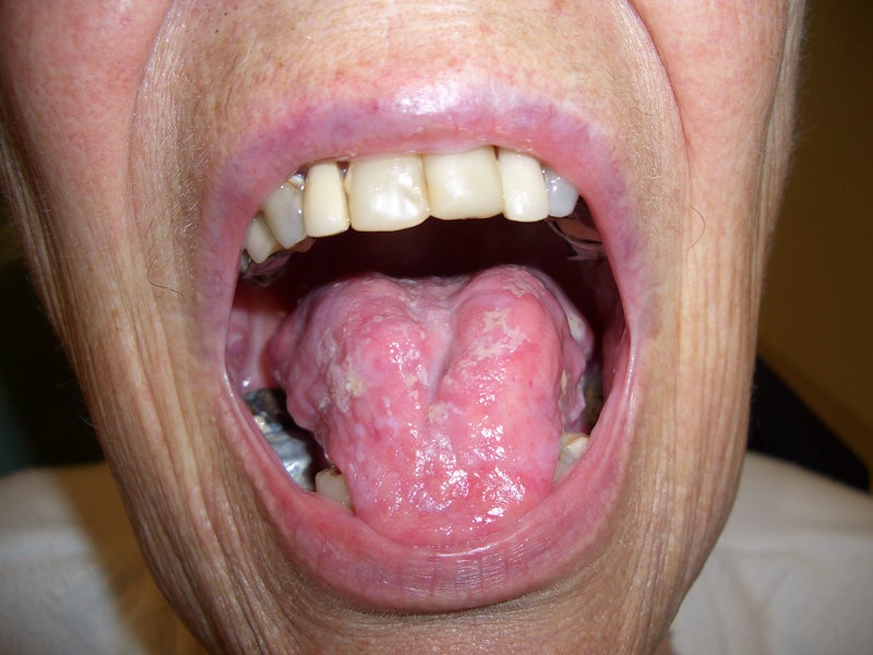Patient's mouth with pseudomembranous candidiasis