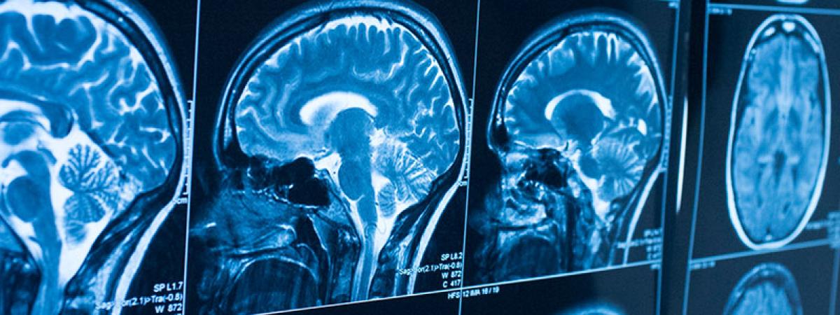 Image of four brain scan images in blue and white, the first three in a saggital section view, and the last one in a horizontal section view