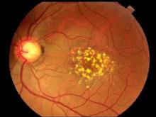 photograph of Drusen visible in a fundus
