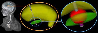 Illustration of Volume of Tissue activation by deep brain stimulation (McIntyre Laboratory)