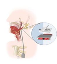Illustration of Selective hypoglossal Nerve stimulation (Durand Laboratory)