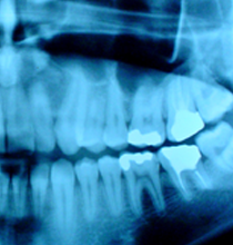 x-ray of jaw