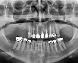 Xray of teeth that has dental work done on them.