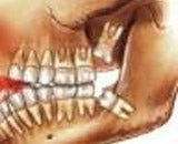 Xray of a person's inside jaw of mouth.