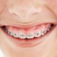 A smile with braces on the teeth.